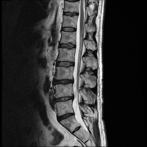 bandscheibenvorfalls bandscheibenvorfalls