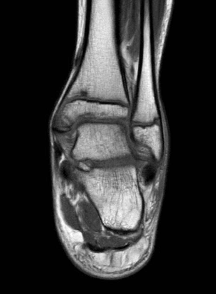 MRTKinder Sprunggelenk