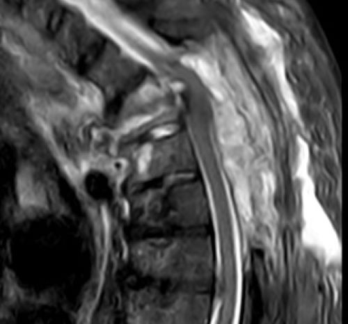 MRTWirbelsaeule Tumor