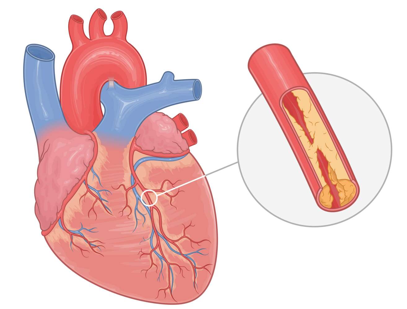 Angina und Blutgefäße