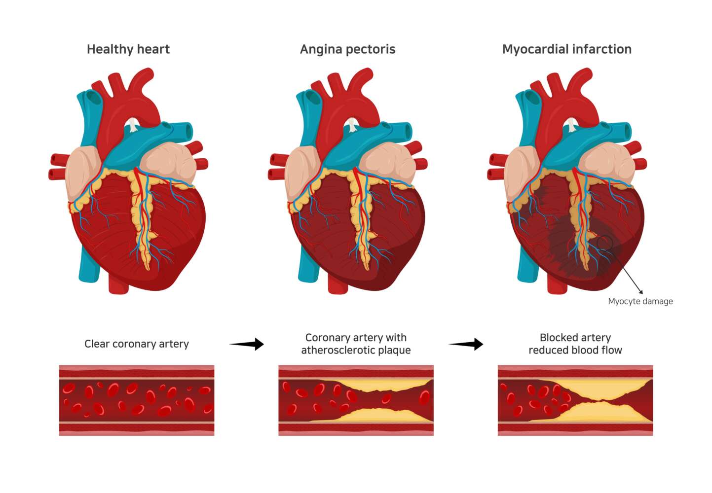 Angina und Herz