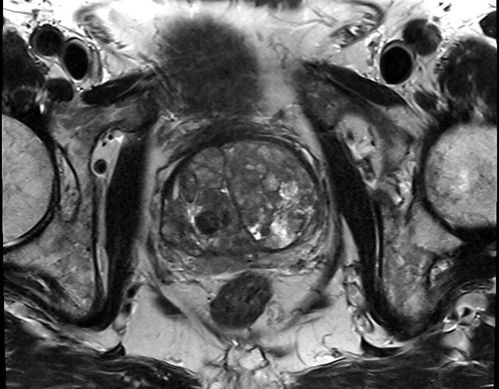 MRTProstata axialAnsicht