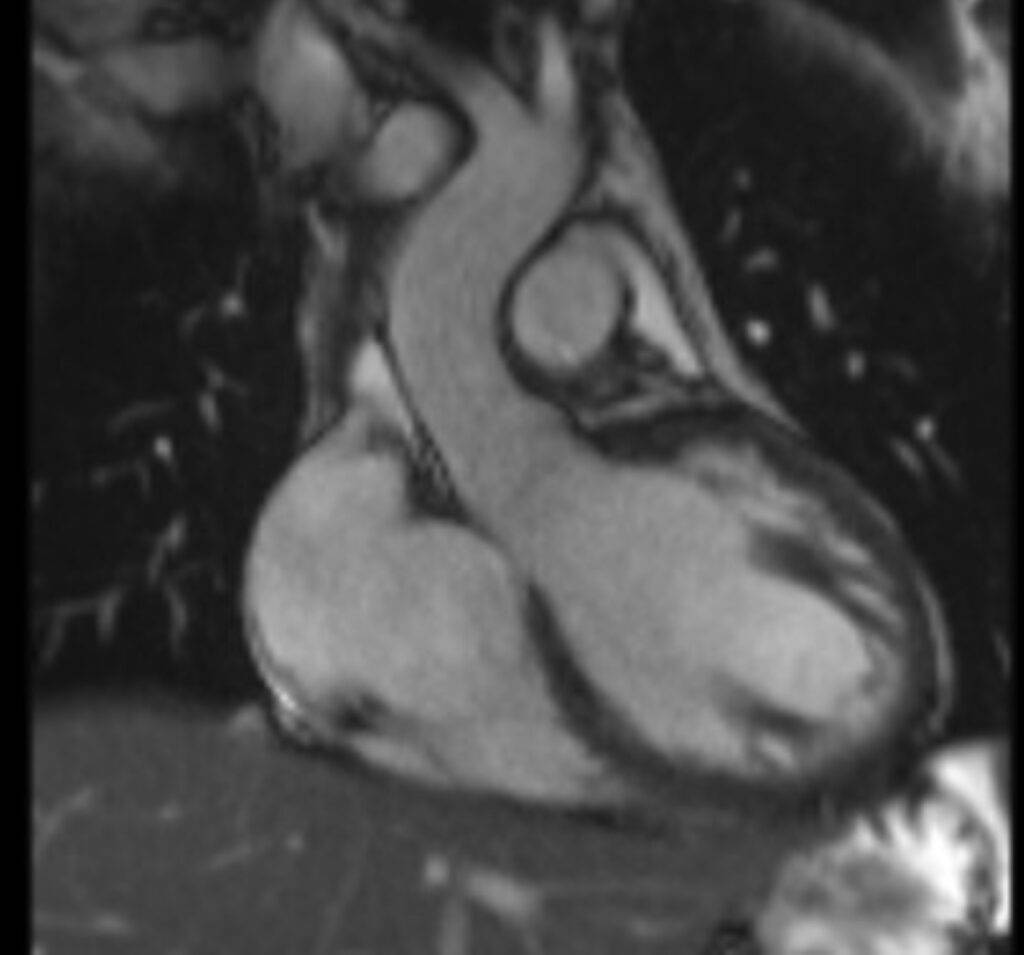 heart-cancer-symptoms_732x549-thumbnail KardioMRT Kammerblick