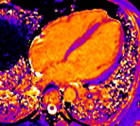 KardioMRT Myocarditis