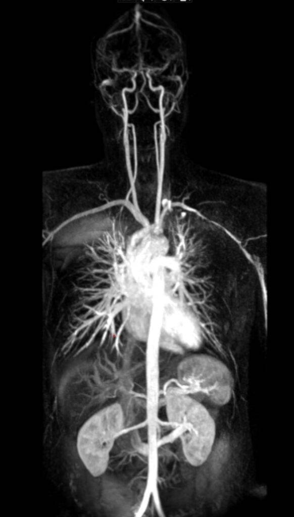 MR Angiographie Gefaesse