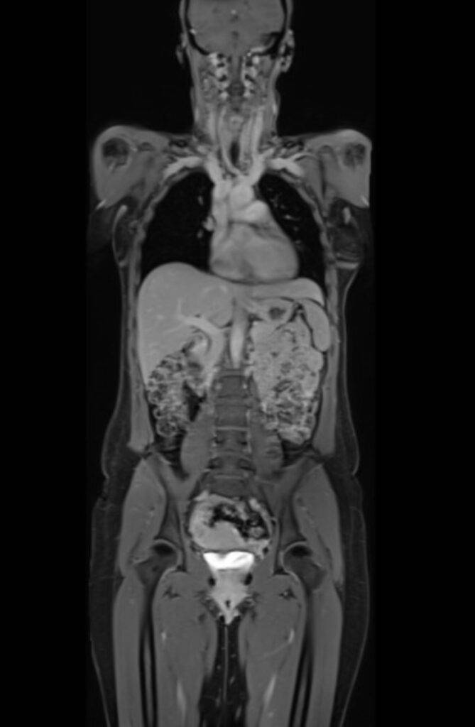 MRTGanzkoerper Kontrastmittel