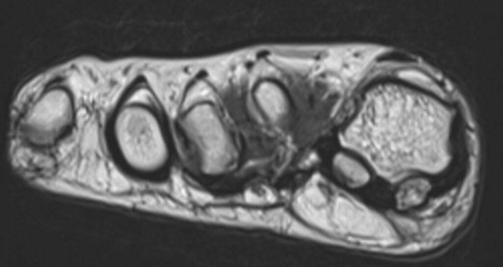 MRTFuss Mittelfussknochen