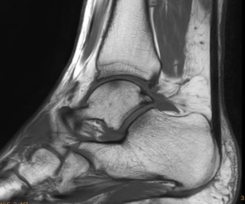 MRTSprunggelenk seitlichAnsicht