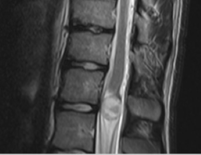 MRT Krebs Spinalkanal Tumor