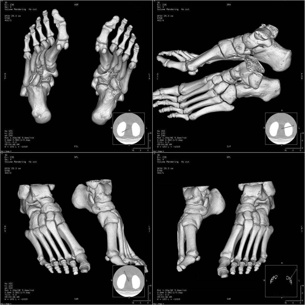 CT foot image CT Fuss