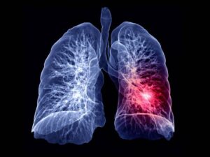 PulmonaryEmbolismExplainer SC