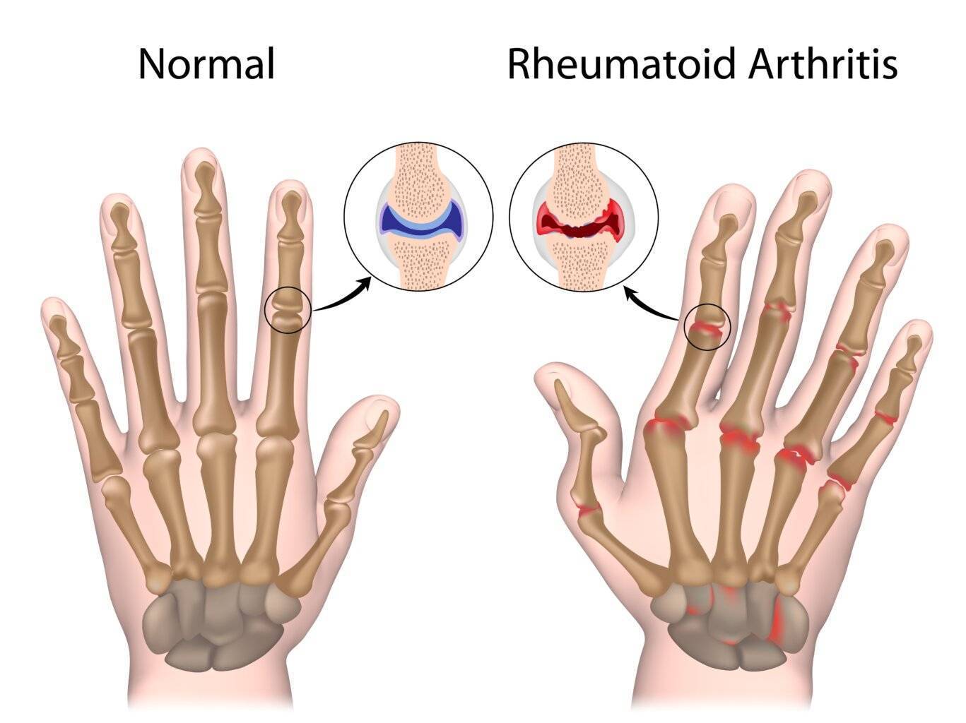 Arthritis Arthritis