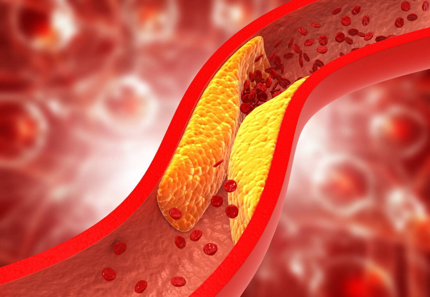 Clogged arteries, Cholesterol plaque in artery Koronare Herzkrankheit