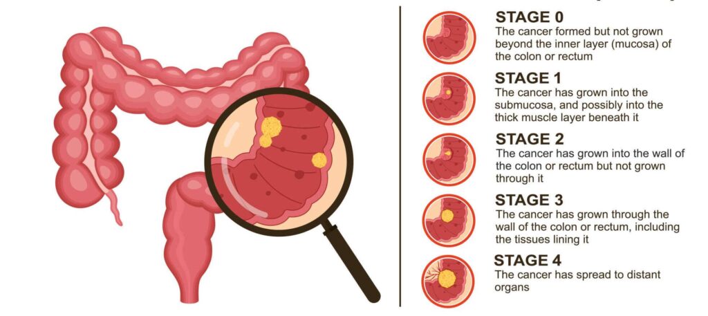 Dickdarmkrebs Dickdarmkrebs