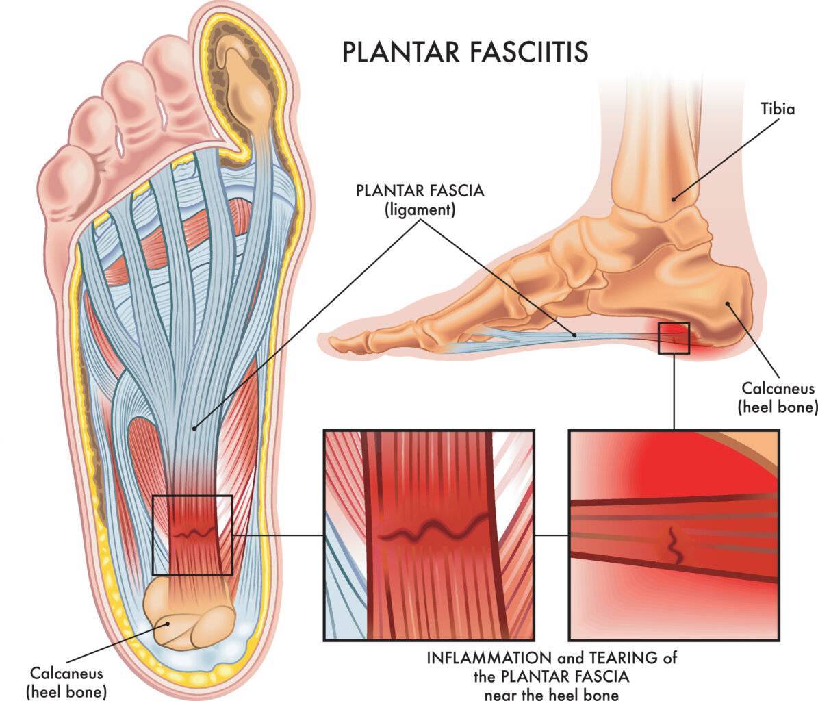 Medical illustration showing section of foot with symptoms of pl Bänderriss am Fuß
