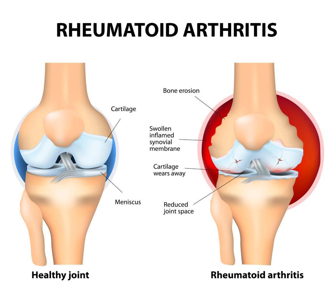 Arthritis Arthritis