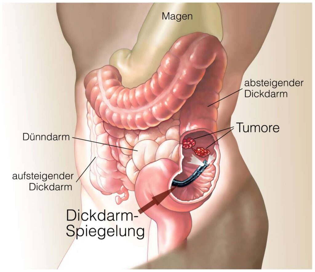 Dickdarmkrebs Dickdarmkrebs