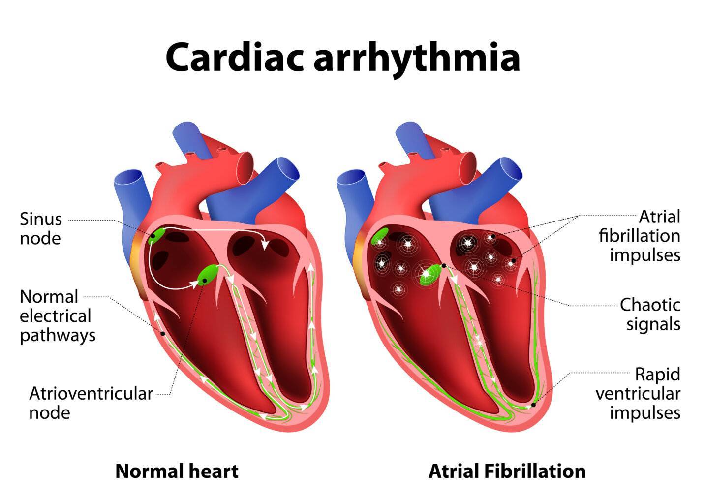 Cardiac arrhythmia Herzrhythmusstoerungen