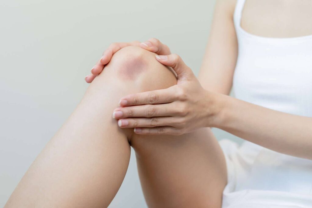 Bone Bruise Bone Bruise