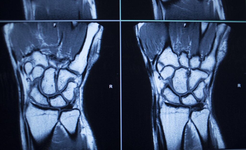 Handgelenksfraktur MRT Handgelenksfraktur MRT