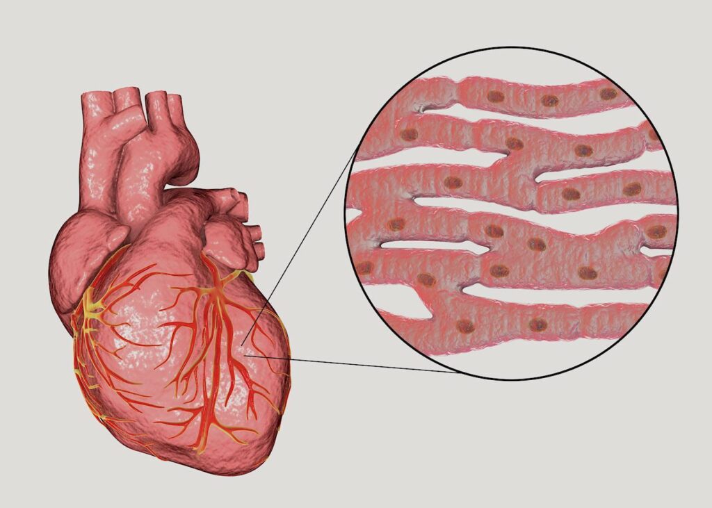Herzmuskelentzündung
