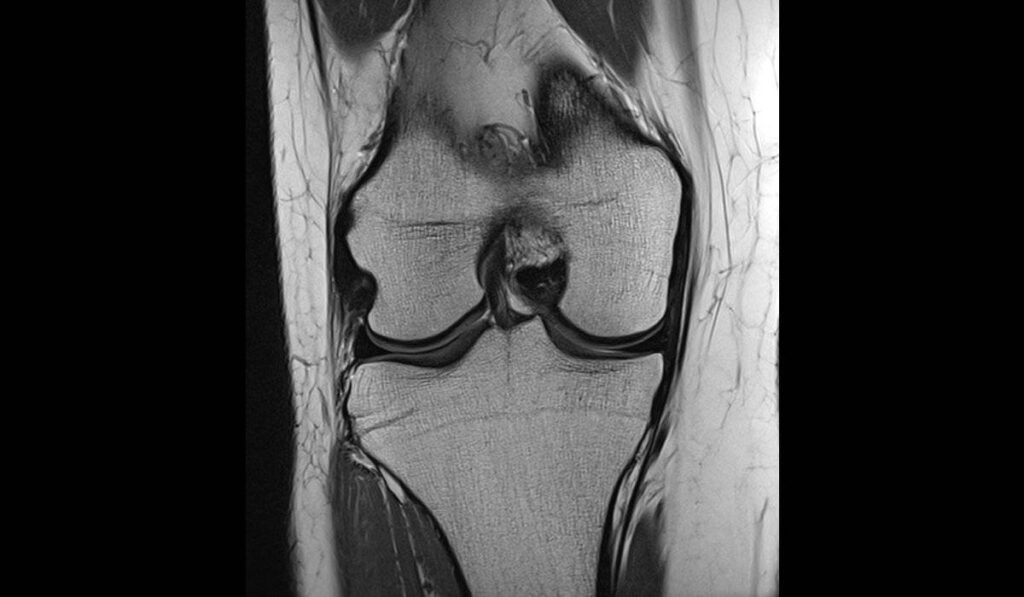 Kreuzbandriss Kreuzbandriss