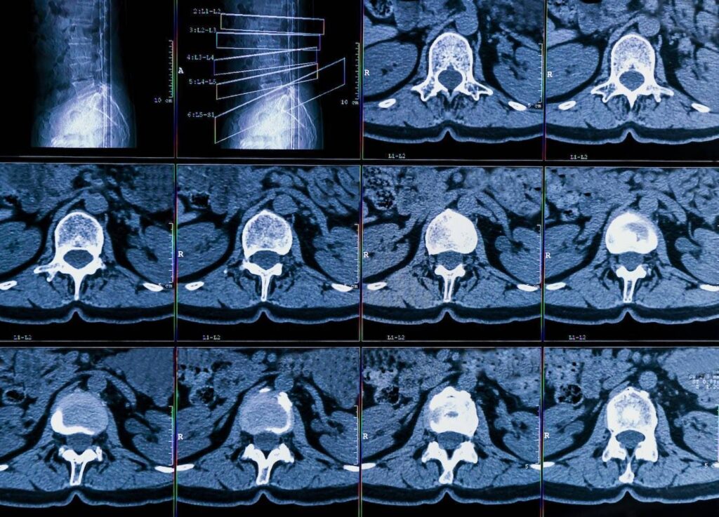 Lendenwirbelsaeule CT schmerzen Lendenwirbelsaeule CT schmerzen