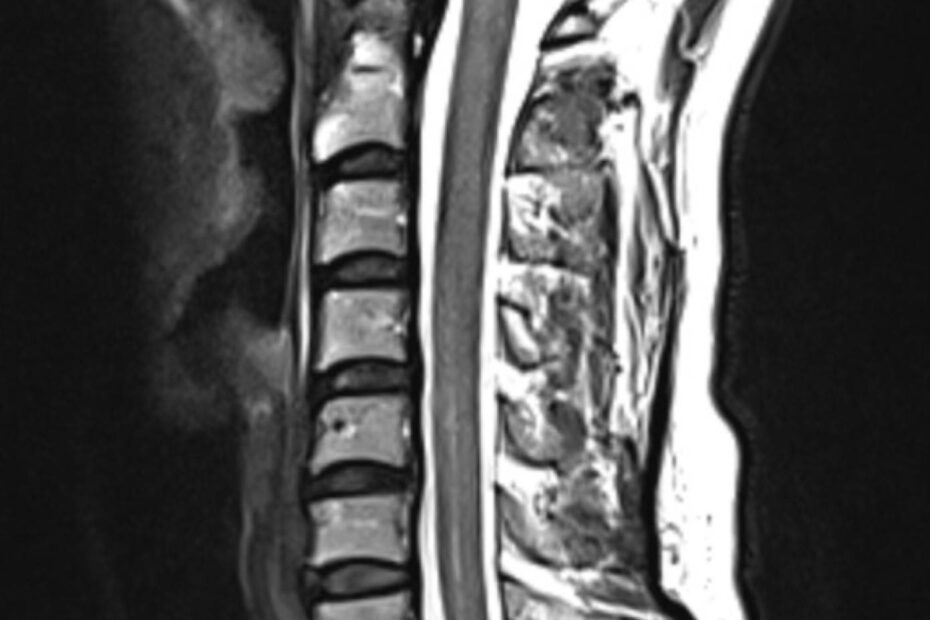 MRT Halswirbelsäule