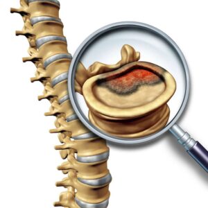 Spine Cancer Knochenkrebs