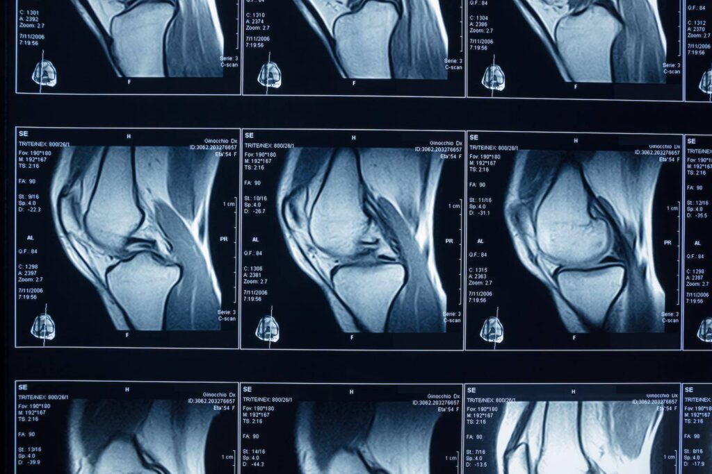 meniscus mri meniscus mri
