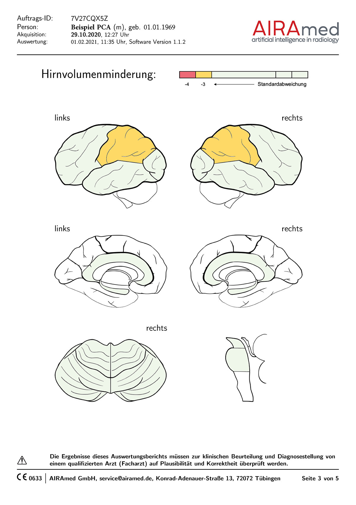 MRT Früherkennung Alzheimer Demenz AIRAscore - 2